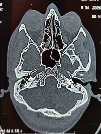 High-resolution computed tomography temporal bone axial cut showing extent of external wall bony erosion inferiorly.